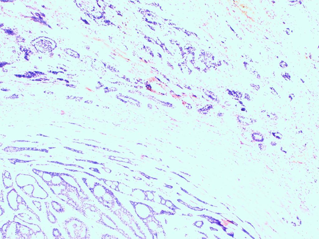 Sitowie z widocznymi niewielkimi zmianami pooperacyjnymi SUM w Katowicach, lub Oddziale Laryngologii i Onkologii Laryngologicznej WSS nr 5 w Sosnowcu.