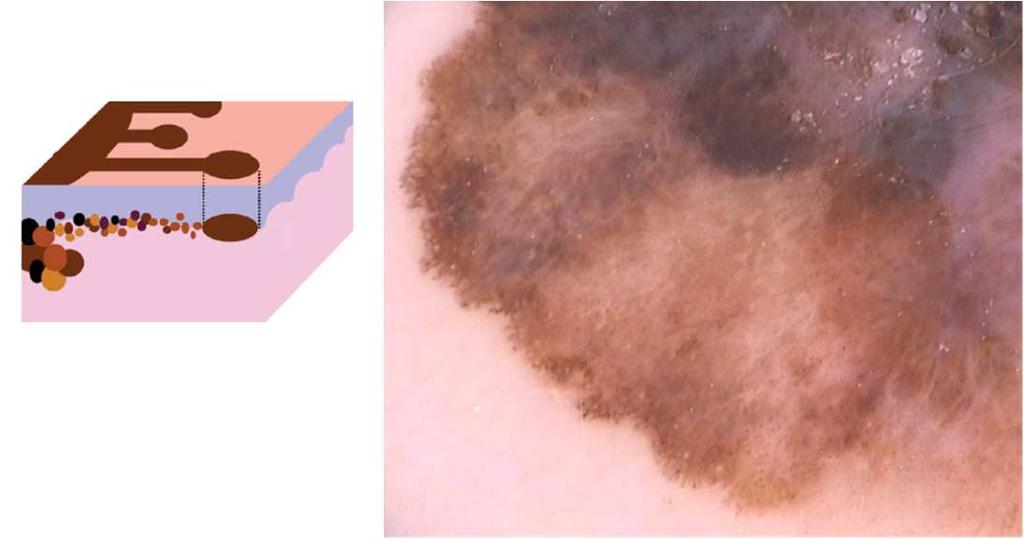 Pseudopodia struktury w czerniaku Atlas of Dermoscopy Second Edition Edited by Ashfaq A.
