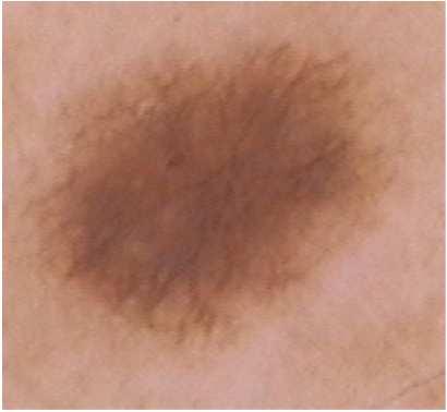 Schemat- Dermatologia