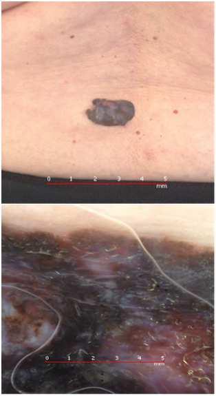 (Nodular   dermatoskopowe własne 18