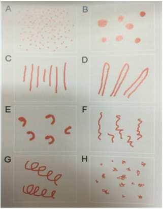 Naczynia krwionośne w dermatoskopii Rodzaje naczyń Rozmieszczenie naczyń Dermatoskopia Algorytmiczna metoda oparta