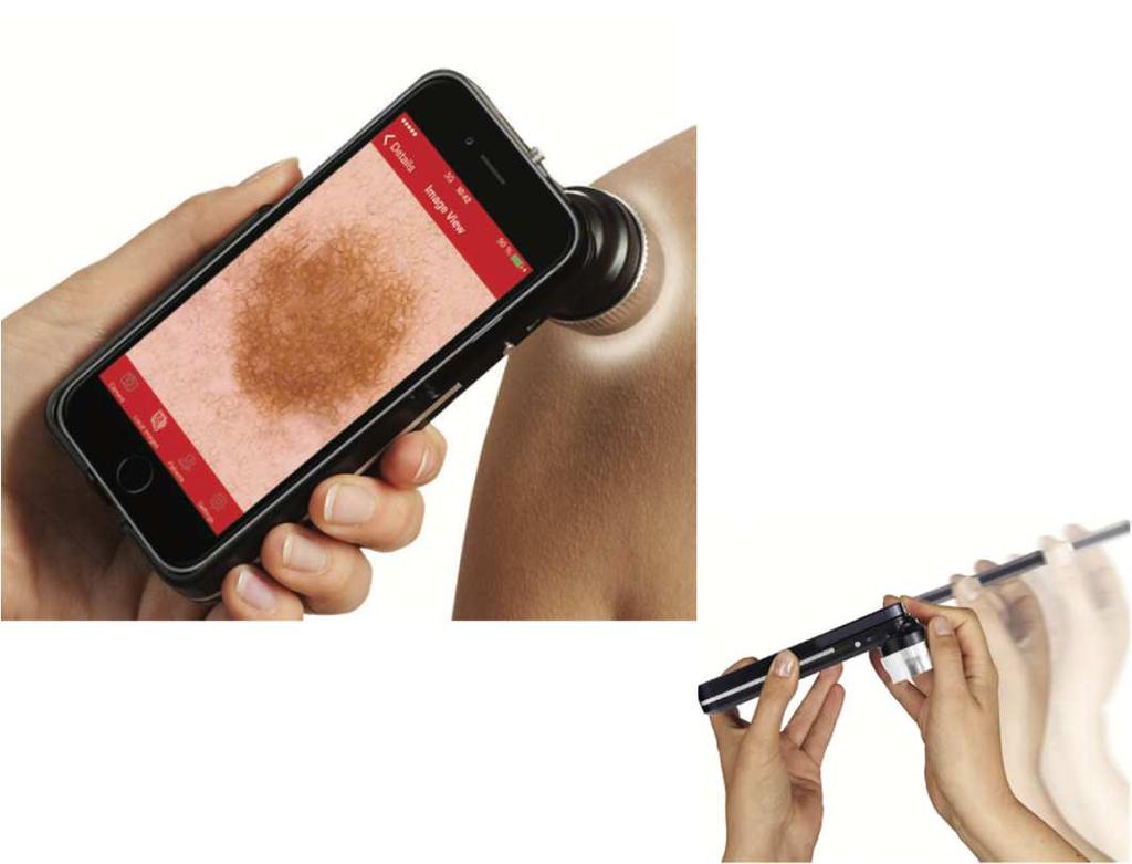 Dermatoskop ZALETY Łatwy w użyciu Niskie koszty Możliwość oglądania miejsc szczególnie trudno dostępnych WADY Brak możliwości