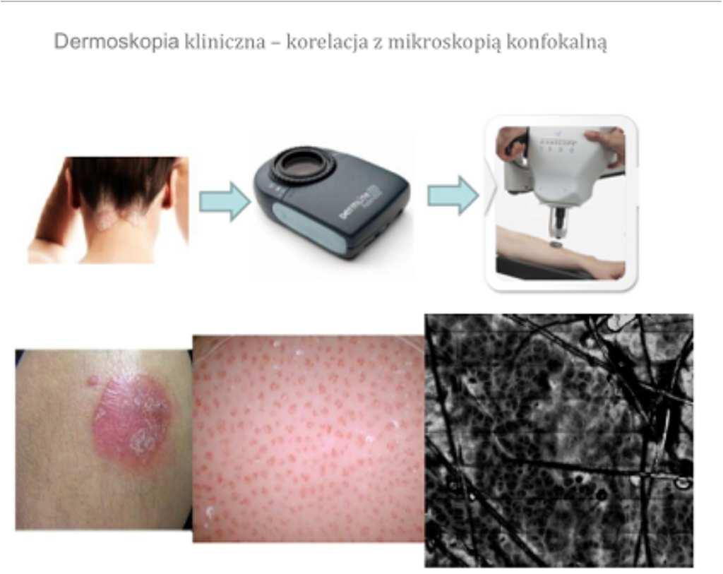 Kurs Dermatoskopii Dr N Med Jacek Calik Dermatoskopia Dermoskopia Mikroskopia 9050