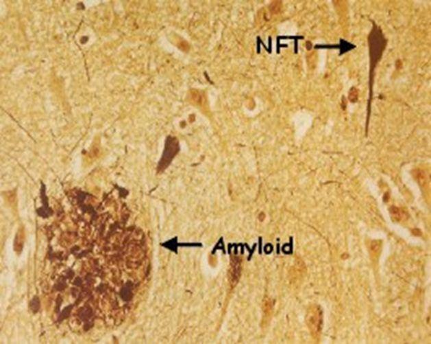 nerwowej, dezintegrując układ transportujący w neuronie. Hiperfosforylowane białko tau łączy się między sobą i tworzy splątki neurofibrylarne (NFT).