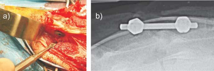 44 L. F. CIUPIK, A. KIERZKOWSKA Tests on goats confirmed the functionality of the implant and the procedure as well as the safety of its application in tissues (Fig.8).