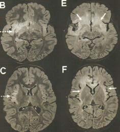 Patofizjologia dystonii dysfunkcja pętli neuronalnych w obrębie jąder podstawy dysfunkcja sieci ruchowych połączeń neuronalnych wykraczających poza basal ganglia: móżdżek wzgórze kora ciemieniowa i