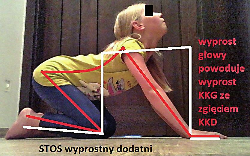 4. Test dodatni STOS ZG Fig. 4. Positive STNR FLX test Badane dzieci podczas przeprowadzania testu miały za mknięte oczy. Sposób badania przedstawiono za pomocą rycin 5 7.