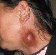 Tularemia Tularemia ostra bakteryjna choroba zakaźna.