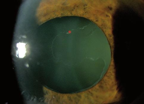 Rozdział 17 Jaskra 167 Rycina 17.5 Przedni odcinek oka pacjenta z zespołem pseudoeksfoliacji (gwiazdką zaznaczono brzeg materiału pseudoeksfoliacyjnego na soczewce).