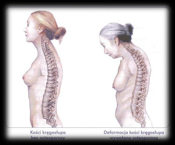 Podział osteoporozy Pierwotna 1.