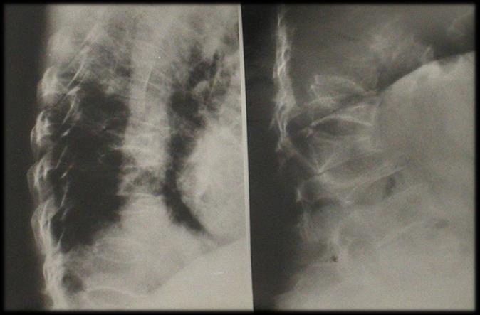 Złamanie kręgu Najczęstsze złamanie osteoporotyczne Ryzyko złamań wzrasta u kobiet w wieku 50-55 lat, u mężczyzn w wieku 60-65 lat i następnie narasta liniowo z wiekiem W większości przypadków
