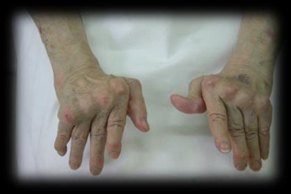 Wtórne przyczyny osteoporozy 3./4.