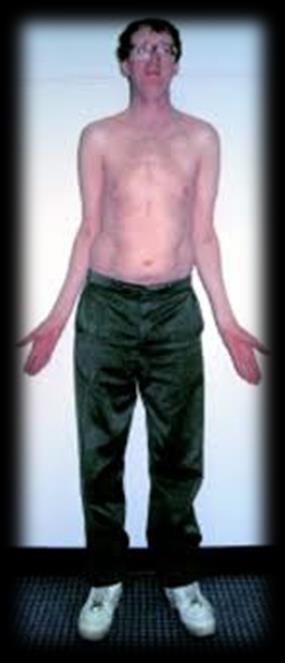 Wtórne przyczyny osteoporozy 7.