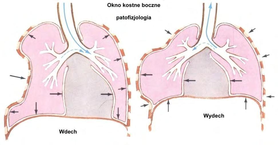 Wiotka klatka piersiowa (cepowata) Powstaje w wyniku złamania co najmniej 3 sąsiednich żeber, gdy każde z nich, złamane jest co najmniej w dwóch miejscach. Wyróżniamy okno kostne : 1. boczne 2.