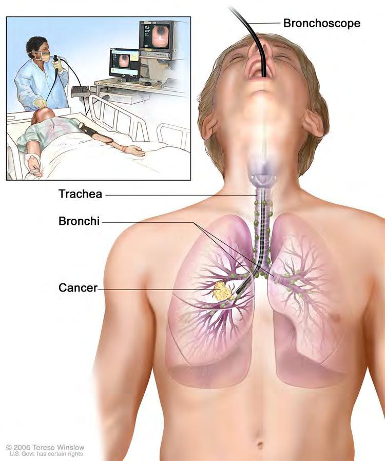 Bronchoskopia wskazania diagnostyczne 1. Krwioplucie 2. Nawracające zapalenie płuc lub dolnych dróg oddechowych zlokalizowane w tym samym miejscu w celu wykluczenia procesu nowotworowego 3.