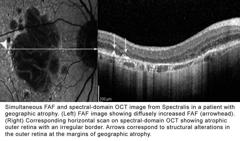 FAF + OCT MyVisionTest