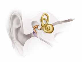 Przy niedosłuchu typu zmysłowo-nerwowego stopnia lekkiego do znacznego stosuje się tradycyjne aparaty słuchowe lub implanty ucha środkowego.
