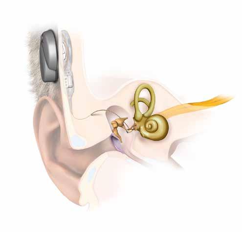 Jak działa VIBRANT SOUNDBRIDGE 3 Implant 1 Dźwięki są zbierane przez mikrofony procesora dźwięku. Procesor dźwięku utrzymywany jest nad implantem siłą przyciągania magnesu.