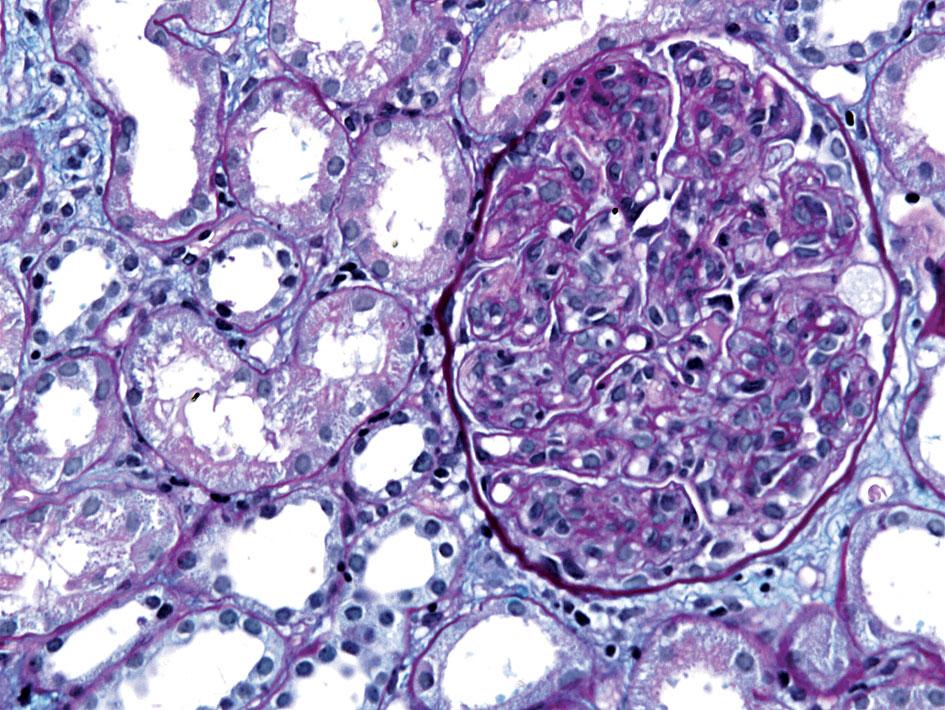 Nieznaczny rozplem mezangialny można stwierdzić również w zmianie minimalnej, ogniskowym i segmentalnym stwardnieniu kłębuszków, glomerulopatii błoniastej i cukrzycowej chorobie nerek. 3.