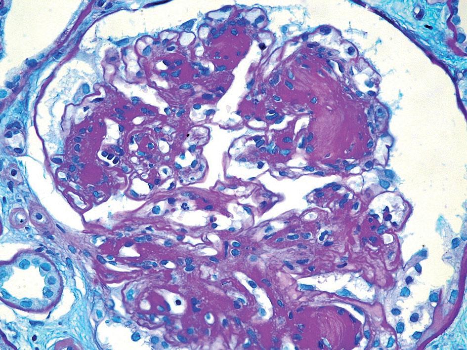 Zapalenia kłębuszkowe z martwicą pętli włośniczkowych zazwyczaj stwierdza się w glomerulopatiach związanych z obecnością przeciwciał ANCA oraz w nefropatii toczniowej.