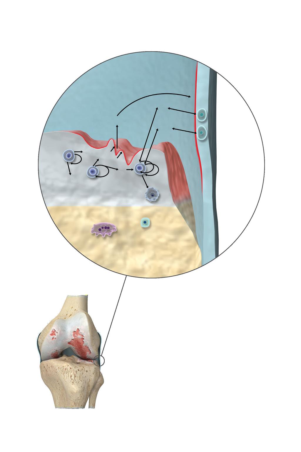 Maź stawowa Błona maziowa IL-1 Produkty rozpadu tkanki TNF-α Agrekanazy IL-8 MMP-13 Komórki błony stawowej Kolagen typu X Chrząstka IL-1 Chondrocyty Apoptoza Osteoklast Osteoblast Kość Rysunek 1.