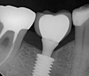 jednym czasie Zdjęcie radiologiczne ostatecznej pozycji implantu