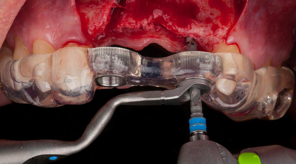 Nawigacja Komputerowa - Korzyści KORZYŚCI DLA LEKARZA: Bezpieczeństwo i komfort zabiegów Optymalne planowanie pozycji implantów ze względu na struktury anatomiczne i jakość kości.