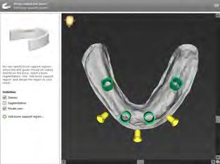 GUIDED SURGERY SOFTWARE codiagnostix jest intuicyjnym i łatwym w użyciu programem do planowania leczenia implantologicznego i projektowania indywidualnych, bardzo precyzyjnych szablonów