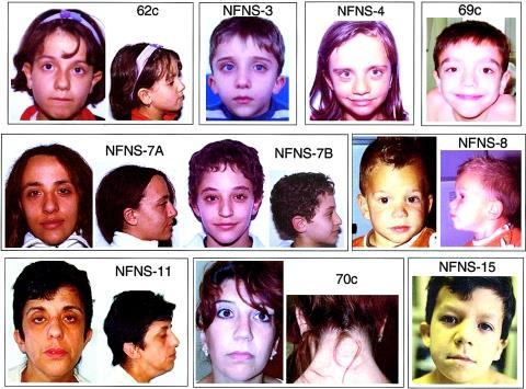 Zespół nerwiakowłókniatowatość - Noonan (NFNS) nerwiakowłókniaki guzki Lischa