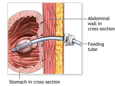 G-tube