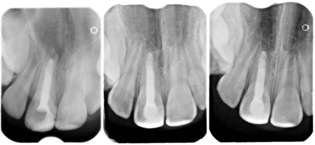 Metody leczenia endodontycznego zębów stałych z niezakończonym rozwojem wierzchołków korzenia rewaskularyzacja... Tab. 3.