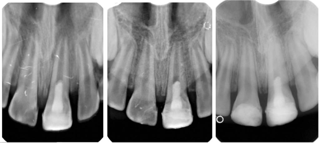 Renata Pazera i wsp. 3M 6M 12M Ryc. 2. Rewaskularyzacja obserwacja 12-miesięczna Dyskusja Martwica lub nieodwracalne zapalenie miazgi są wskazaniem do leczenia endodontycznego.