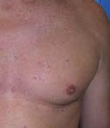 GŁOWICA AFT SHR TM Metoda epilacji Alma Super Hair Removal (SHR) działa na zasadzie stopniowego ogrzewania skóry właściwej do temperatury, w której dochodzi do uszkodzenia mieszków włosowych i