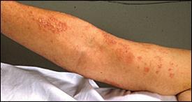 Dermatitis Herpetiformis Choroba Dühringa,
