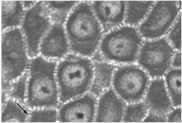 mechanicznych połączeń międzykomórkowych - desmosomy gromadzenie w cytoplazmie