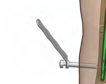 Po zaznaczeniu na skórze punktów, w których należy wywiercić otwory w trzonie kości, wykonać nacięcia tkanek miękkich przechodzące przez wyznaczone punkty na długości około 1,5 cm.