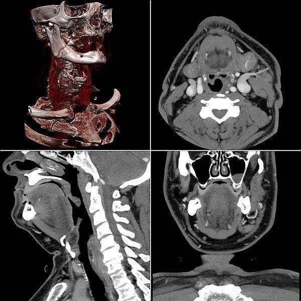 Magnetic resonance imaging (MRI) has better tissues contrast, but CT has better geometric accuracy if enough slices are used.