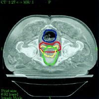 Figure: CT MRI image fusion: delineation of the clinical target volume (CTV) and critical organs.