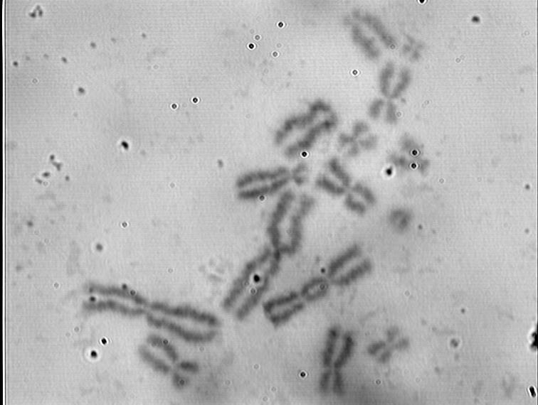 Aberracje chromosomowe