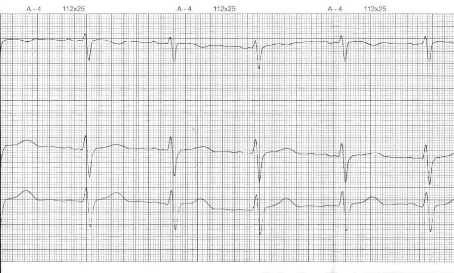 4. Obejrzyj film ilustrujący pracę serca, a następnie spróbuj zaznaczyć na elektrokardiogramie (czyli elektronicznym zapisie pracy serca) moment skurczu przedsionków i komór. 5. Wykonaj ćwiczenie 11.