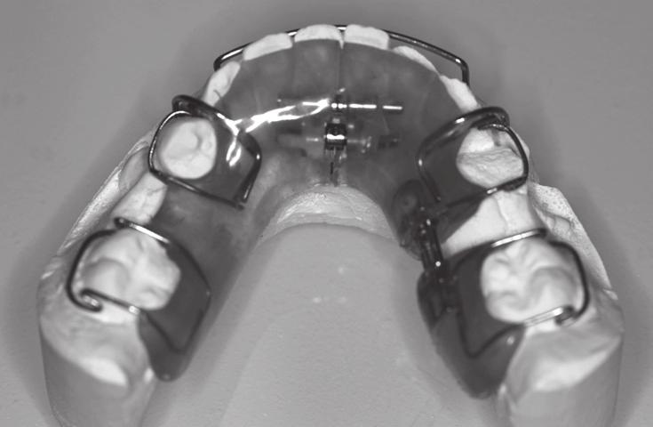 Early stage of reinclusion of teeth 75 and 85 Rycina 11.