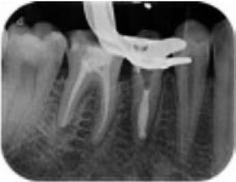 Management of internal root resorption and open apex induced using MTA cement as root canal filling material (tooth