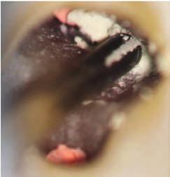 (tooth 36); a) preoperative intraoral radiograph of the first left lower molar showing an enlargement associated with a fuzzy appearance