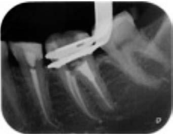 pulp space and the abnormal apposition of dentin/bone-like hard tissue; e) after chemomechanical and ultrasonic removal of pathological