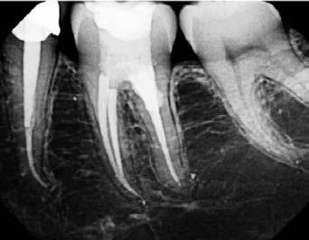 the resorbed area; f) peroperative clinical view of the MTA material placed in the resorbed area and g) the immediate X-ray to assess