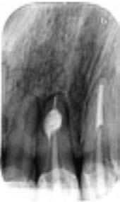 (tooth 11): a) preoperative view: presence of a sinus tract; b) preoperative