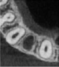Diagnosis of an apical internal root resorption in a 16-year old patient at the end of orthodontic treatment (tooth 12): a) extraoral photograph: the