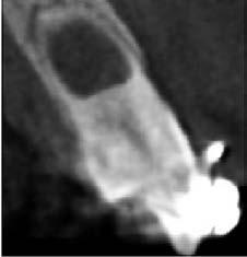 (possibly false positive); b) panoramic radiograph: note the apical resorption of the right upper lateral incisor; c) periapical radiograph confirms the