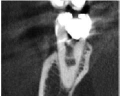 w CBCT potwierdzają resorpcję wewnętrzną bez perforacji ścian korzenia; e) widok kliniczny jamy resorpcyjnej pod