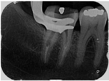 Management of internal root resorption with endodontic treatment and complete root canal filling with warm gutta
